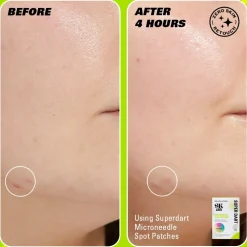 Revolution Beauty Revolution Skin Super Dart Microneedle Salicylic Acid Hydrocolloid Spot Patches 9 Patches^ Salicylic Acid|Hyaluronic Acid